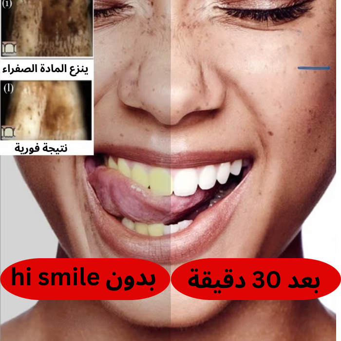 مبيض الأسنان في 30 دقيقة Hi Smile